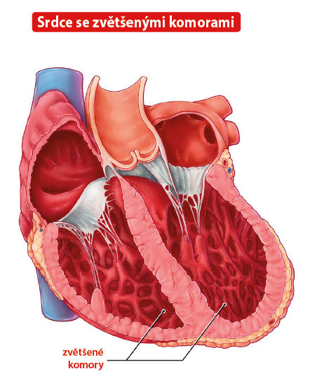 Srdce se zvětšenými komorami